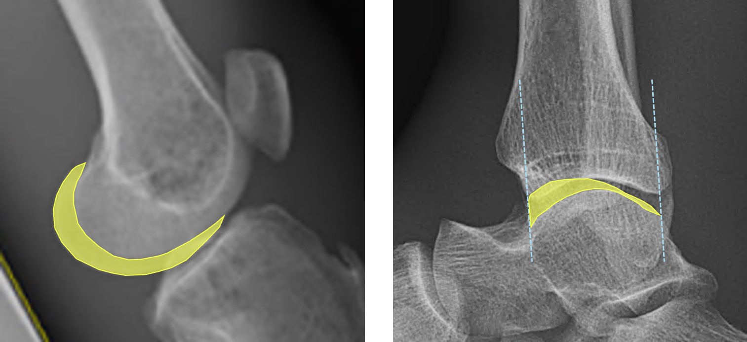 Precise segmentation and left/right judgment technologies for digital radiography